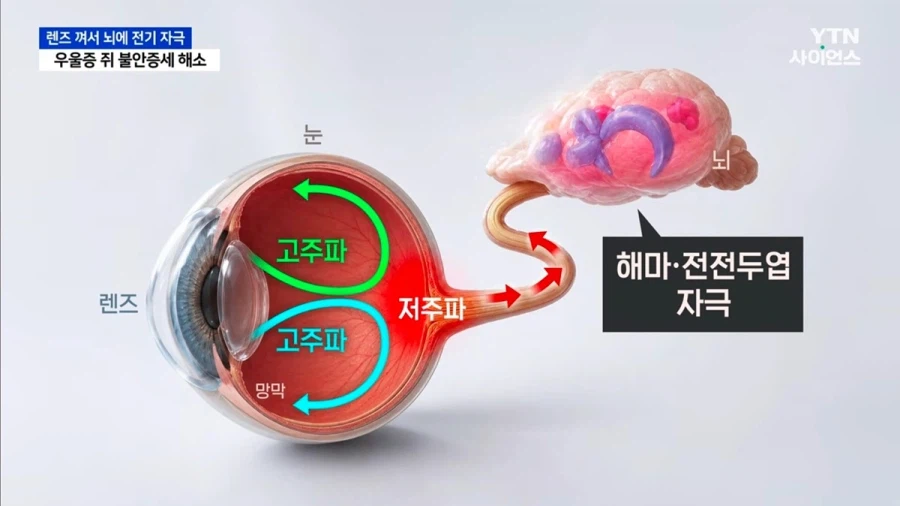 (우울증 치료용 렌즈) 상상도 못한 우울증 치료...국내 연구진이 또 해냈다