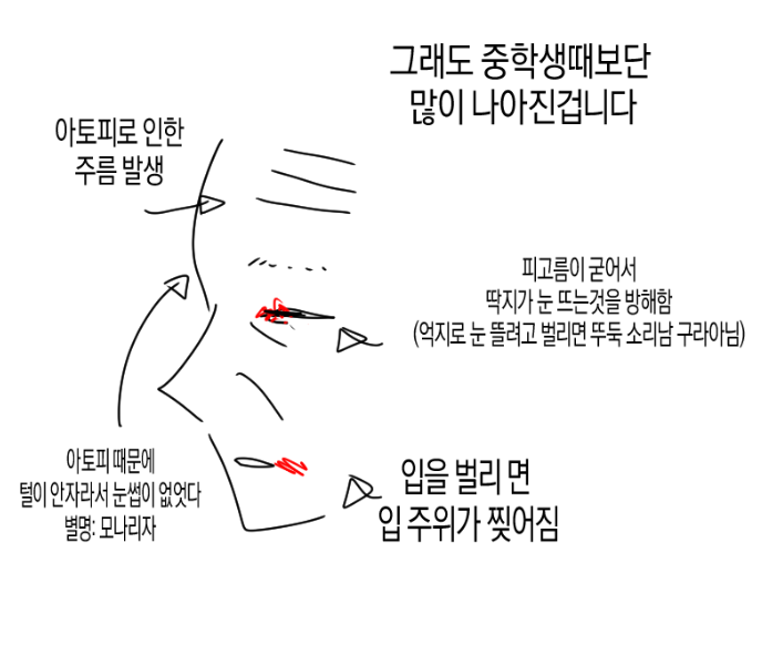 (충격) 아토피가 𝙅𝙊𝙉𝙉𝘼 힘든 이유..JPG