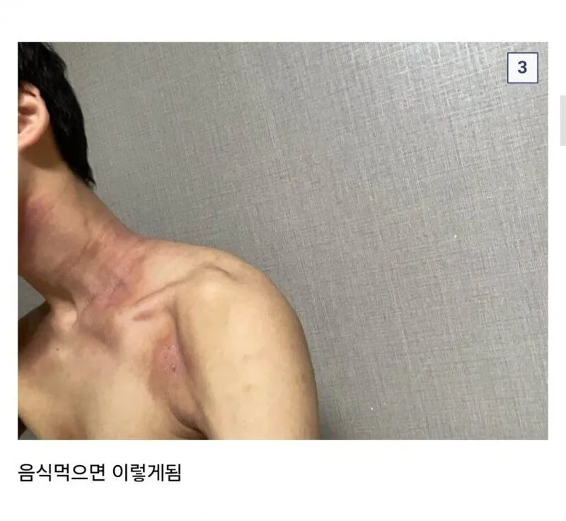 쌀 알레르기 있는데 군대 가는 썰