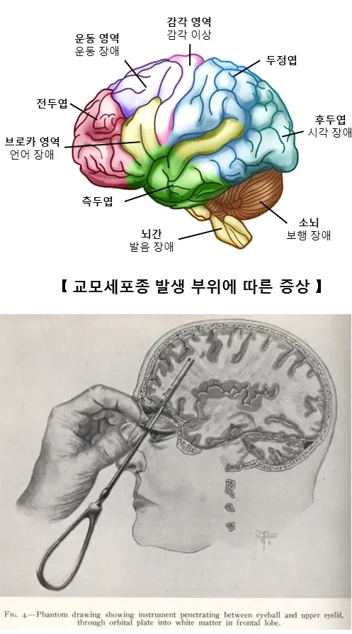 인류가 알고 있는 유일한 조현병 완치법