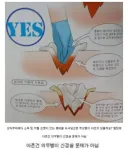 "상처 부위에 소독성분 붕대를 쑤셔넣으면 아프지 않아요?"