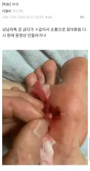 [혐] 티눈갤의 새로운 광인