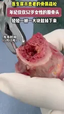 골다공증 걸린 뼈 근황