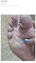 티눈갤)혐주의) 여자임 남자임??