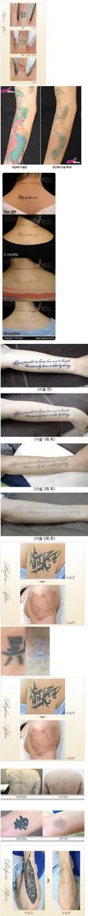 문신 제거 수술 전후...