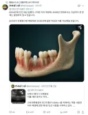 일본 치아 재생 근황