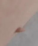 몸에 이런거 나는걸 뭐라 함?