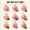 꼴릿 꼴릿 벌레물린 자국