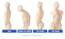 은근 잘못 알고 있는 사람이 많다는 척추측만증 원인