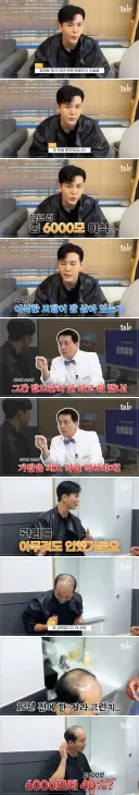 모발 이식후 12년동안 탈모약 안먹었을 때