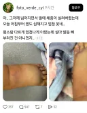 그저께 넘어졌는데 발이 너무 아파