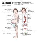 쿠싱 증후군