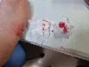 혐) 티눈 이거 피가 은근 많이 나네