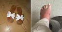매장 진열 샌들 맨발에 신었다가... 박테리아 감염으로 '패혈증' 위기까지