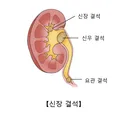 요로결석에 가려져있는 질병