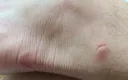 모기물렸을때 제일 ㅈ같은 부위 한곳물림