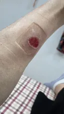 다친거 인증시즌이야!?(화상방치했다가 약사, 의사한테 혼남)