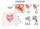 인류의 수명을 거의 두배로 늘려준 수술
