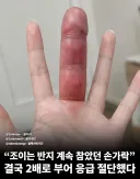 조이는 반지에 2배로 부은 손가락... 반지의 위험성