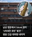 남성 항문에서 발견된 1차 세계대전 포탄 실제 모습