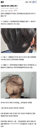 3달만에 머리 다빠진 후기