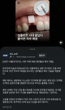 오...치아 재생...
