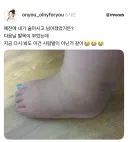 발목 부었을 때 사진.jpg