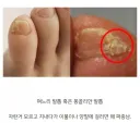 새끼발가락에 생기면 매우 거슬리는 것.jpg