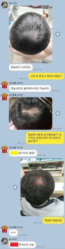 탈모가 고민인 친구
