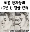 비염 환자들의 10년 간 얼굴 변화