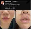 인중 축소 3년차인데 이렇게 절개하는 게 맞아?
