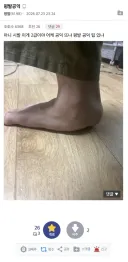 2급 판정 받은 평발