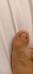 혐) 내성발톱 해결기