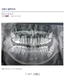 특이한 사랑니 엑스레이 사진들.jpg