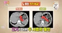 한국인 췌장 vs 서양인 췌장.jpg