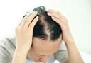 이마 점점 넓어지고 머리 텅 비었다…요즘 젊은 사람들 탈모 확 늘어났다는데