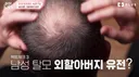 남성 탈모 유전에 대해 밝혀진 사실.jpg