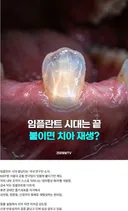 임플란트 업체들이 싫어할 소식