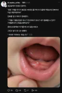 아기 잇몸에 사탕이 박혀 응급실에 감