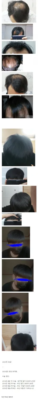 모발이식에 천만원 투자한 사람