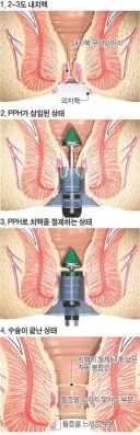 항문 크기가 4cm라는건 생구라임