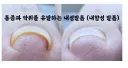 내성 발톱 해결 방법..